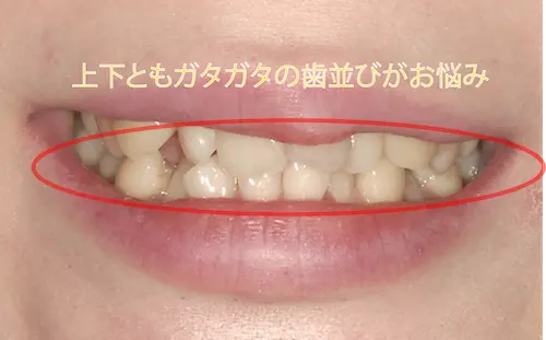 オールセラミックの悩み｜東京都港区青山