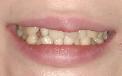 オールセラミックbefore｜東京都港区青山