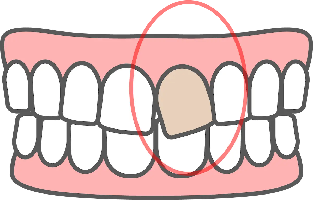 差し歯｜東京都港区青山一丁目の歯医者