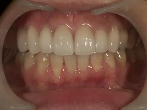 黒くなった差し歯のやり直し(アフター)