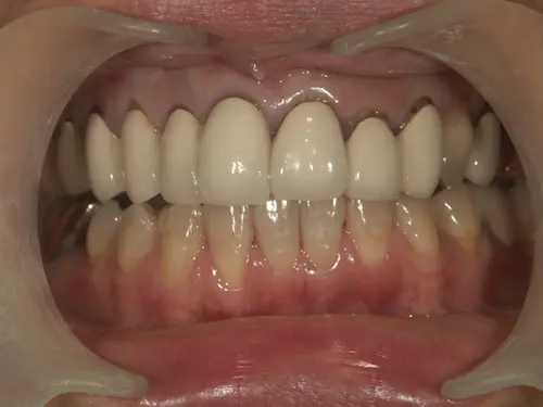 黒くなった差し歯ビフォー