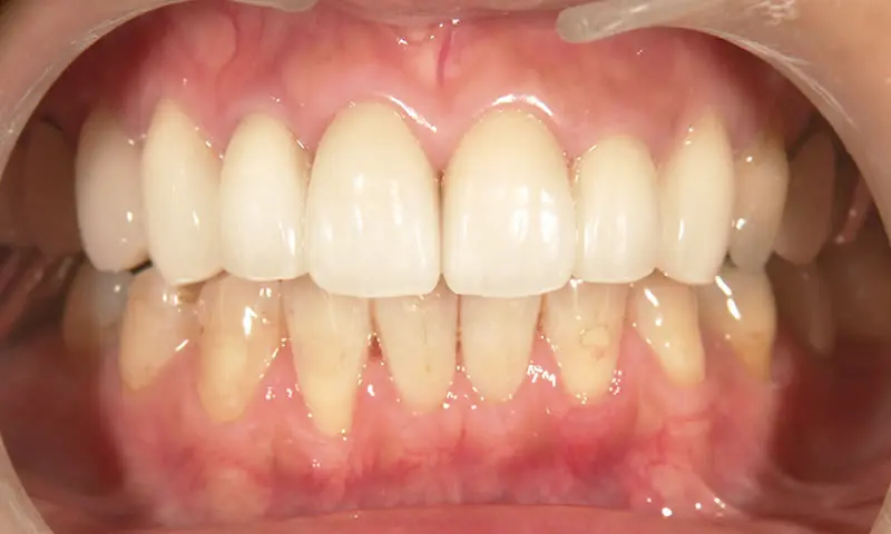 東京都港区青山の歯医者 プレスセラミックについて