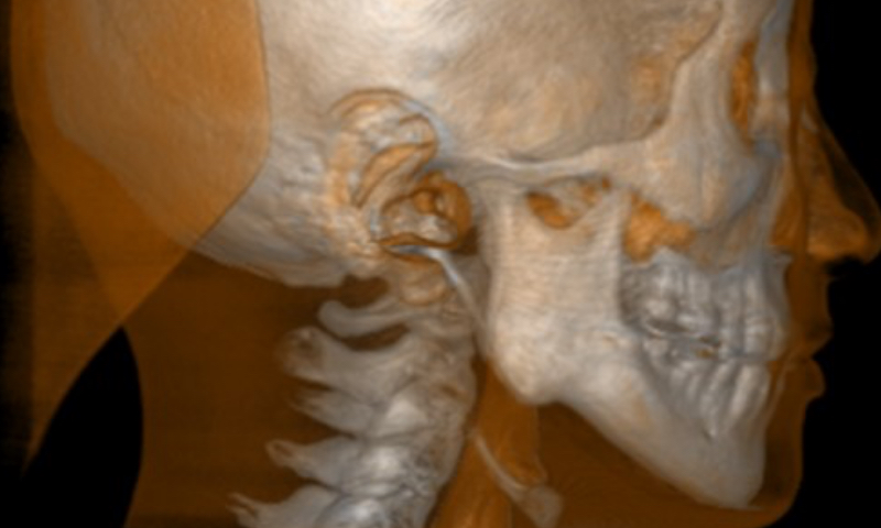 東京都港区青山の歯医者 360°スキャンで金属アーチファクトの発生が少ない。