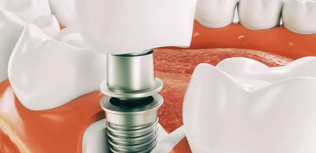 港区青山にある青山一丁目の歯医者　インプラント