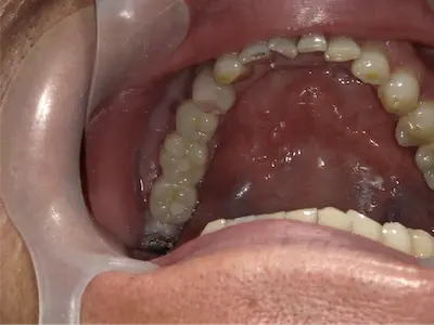 痛くないインプラントの症例 アフター | 東京・港区・青山