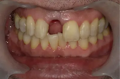 痛くないインプラントの症例 ビフォー | 東京・港区・青山