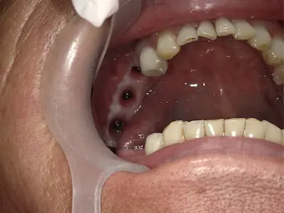 痛くないインプラントの症例 ビフォー | 東京・港区・青山