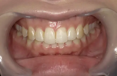 出っ歯の部分矯正 アフター｜東京・港区の歯医者