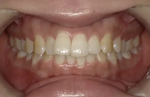 出っ歯の部分矯正 ビフォー｜東京・港区の歯医者