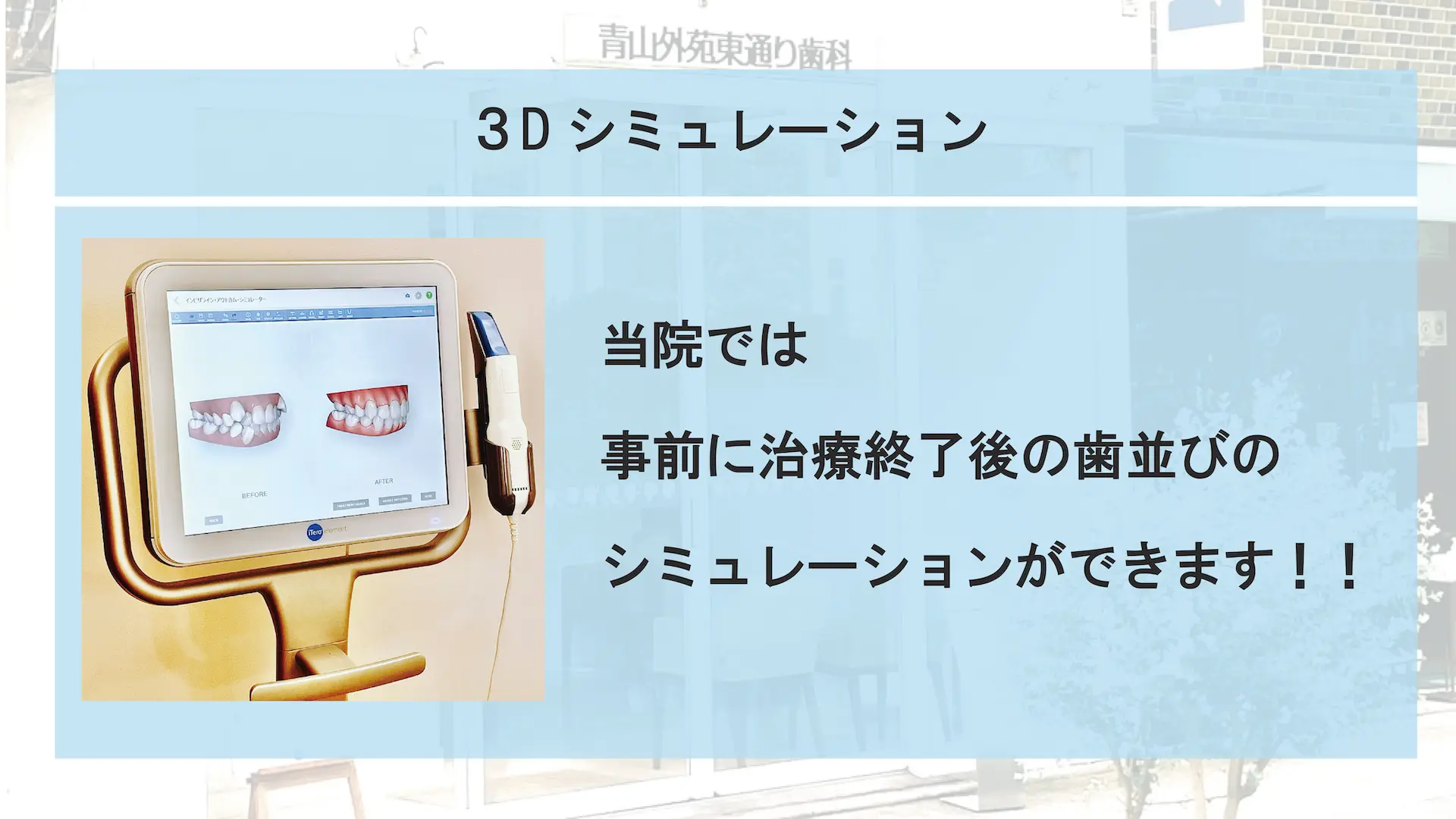 青山の青山一丁目で前歯だけの矯正、マウスピース部分矯正の３Dシミュレーション