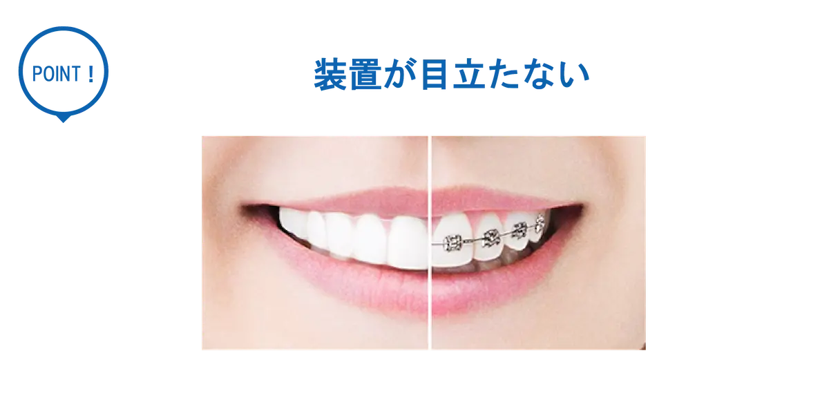 部分矯正インビザラインGOは目立たない