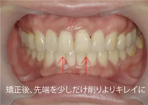 マウスピース矯正 アフター｜東京・港区