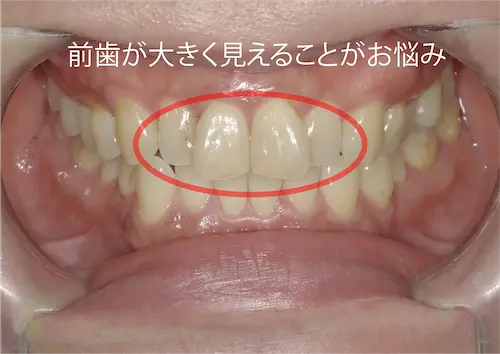 マウスピース矯正 ビフォー | 東京・港区
