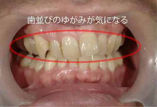 マウスピース矯正 ビフォー | 東京・港区