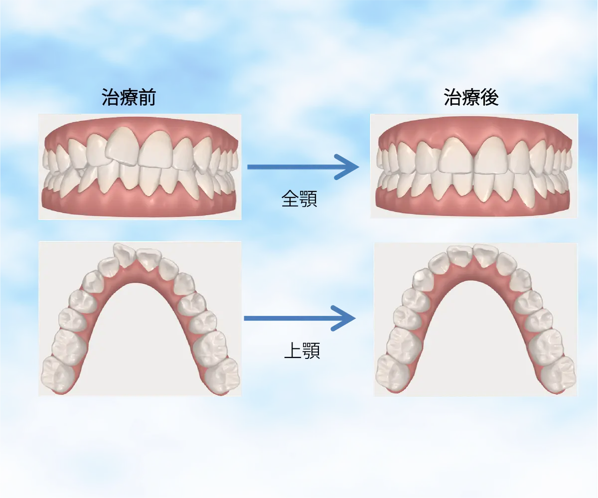 マウスピース矯正の治療計画 | 東京・港区